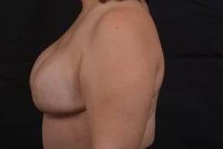 Immediate Breast Reconstruction – Skin Sparing Before & After Gallery - Patient 358522 - Image 4