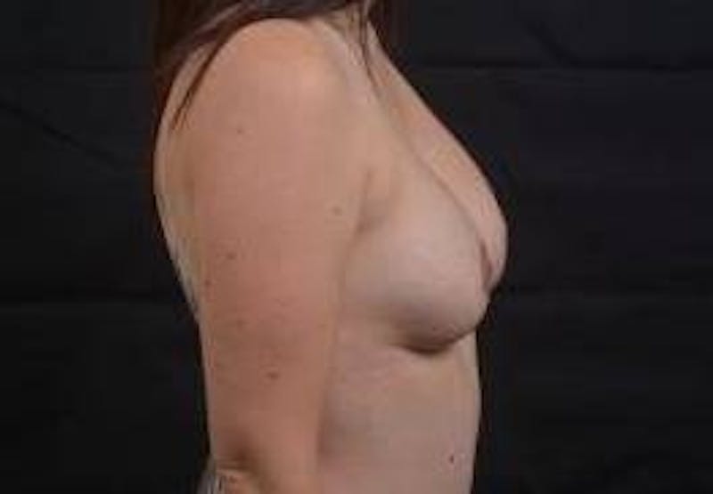 Aesthetic Breast Revision Before & After Gallery - Patient 385454 - Image 6