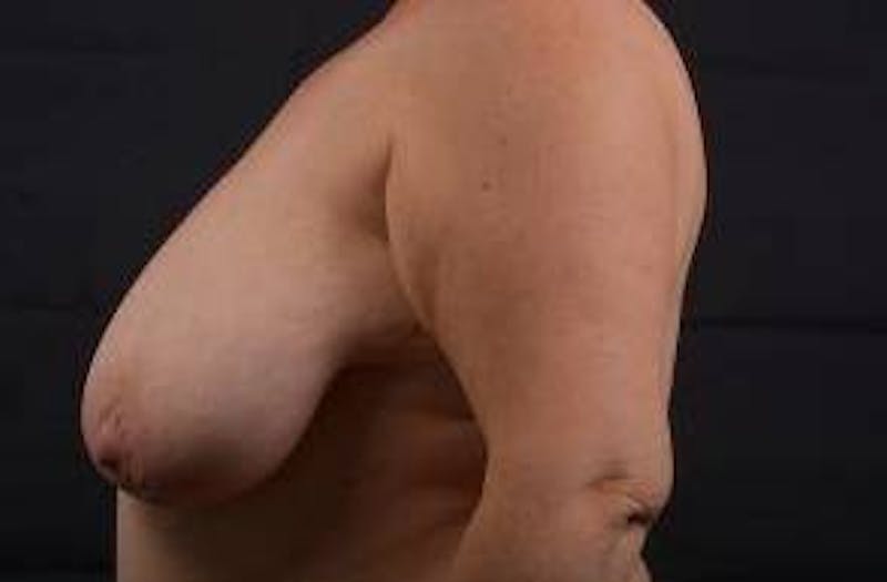 Mastopexy Before & After Gallery - Patient 601059 - Image 3