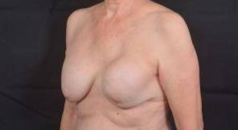 Breast Augmentation Mastopexy Before & After Gallery - Patient 563443 - Image 7