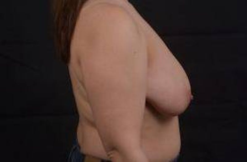 Immediate Breast Reconstruction – Skin Sparing Before & After Gallery - Patient 358522 - Image 5