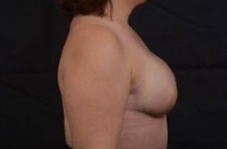 Immediate Breast Reconstruction – Skin Sparing Before & After Gallery - Patient 358522 - Image 6