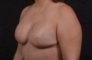 Immediate Breast Reconstruction – Skin Sparing Before & After Gallery - Patient 358522 - Image 8