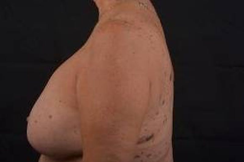Reconstructive Breast Revision Before & After Gallery - Patient 347729 - Image 3