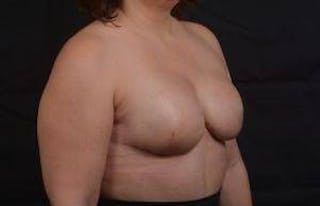 Immediate Breast Reconstruction – Skin Sparing Before & After Gallery - Patient 358522 - Image 10