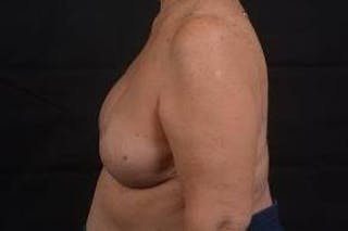 Reconstructive Breast Revision Before & After Gallery - Patient 347729 - Image 4
