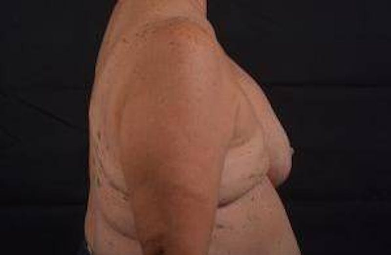 Reconstructive Breast Revision Before & After Gallery - Patient 347729 - Image 5