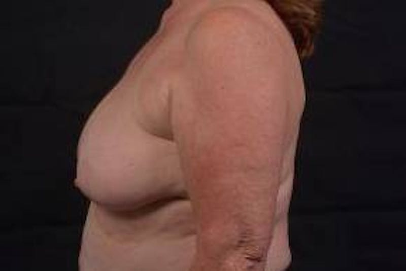 Immediate Breast Reconstruction – Skin Sparing Before & After Gallery - Patient 162765 - Image 3