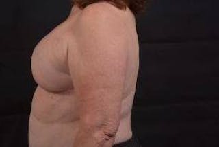 Immediate Breast Reconstruction – Skin Sparing Before & After Gallery - Patient 162765 - Image 4