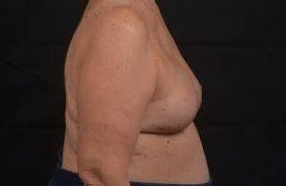 Reconstructive Breast Revision Before & After Gallery - Patient 347729 - Image 6