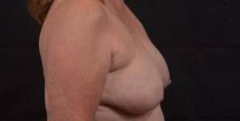 Immediate Breast Reconstruction – Skin Sparing Before & After Gallery - Patient 162765 - Image 5