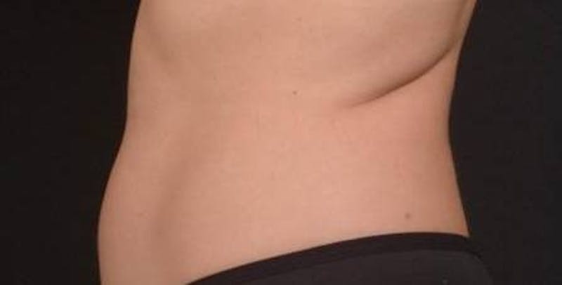BodyTite Before & After Gallery - Patient 364036 - Image 3