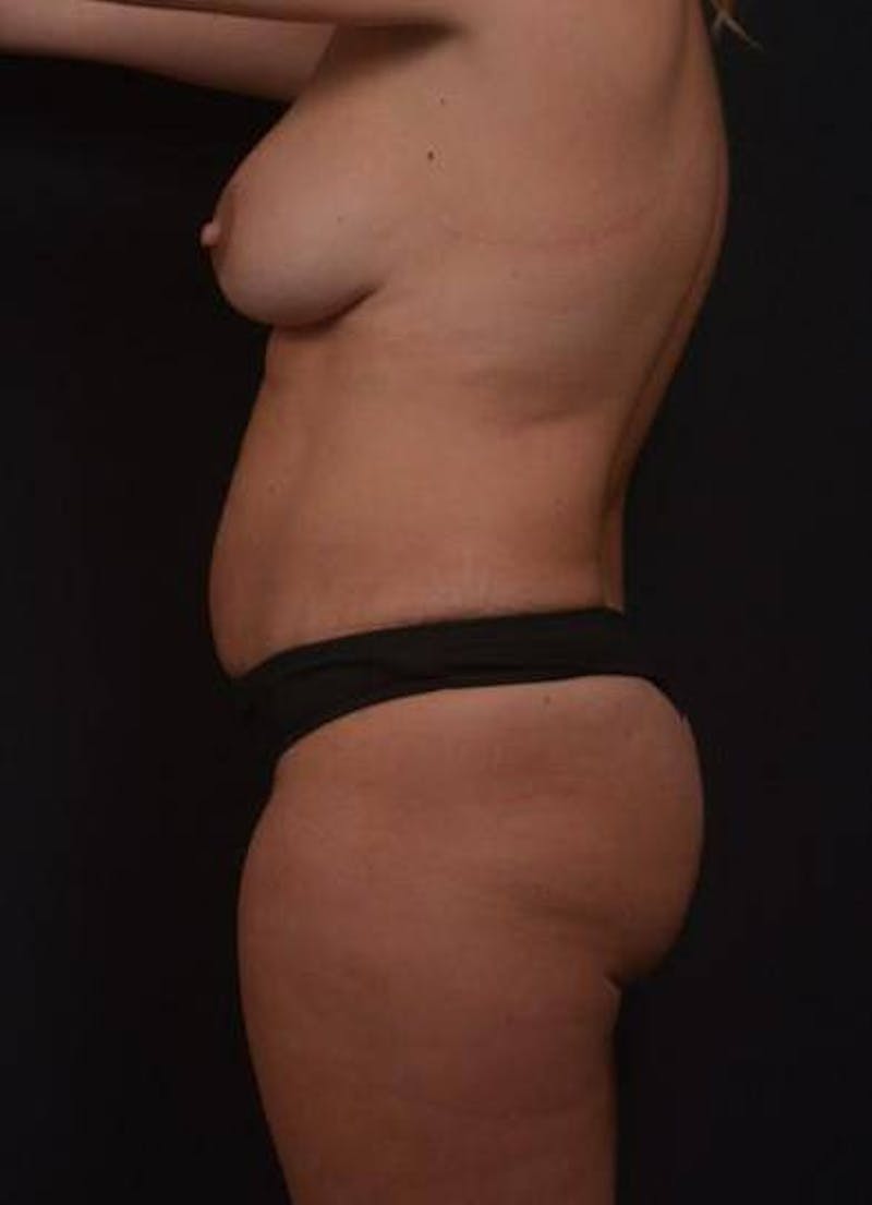 360 Liposuction Before & After Gallery - Patient 351706 - Image 5