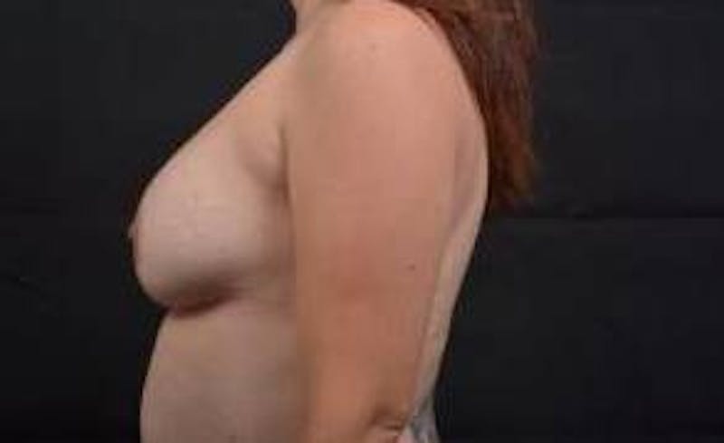 Breast Augmentation Mastopexy Before & After Gallery - Patient 154355 - Image 3