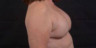 Immediate Breast Reconstruction – Skin Sparing Before & After Gallery - Patient 162765 - Image 6