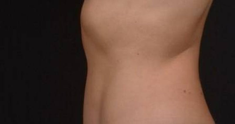 BodyTite Before & After Gallery - Patient 364036 - Image 4