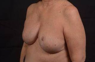 Reconstructive Breast Revision Before & After Gallery - Patient 347729 - Image 8