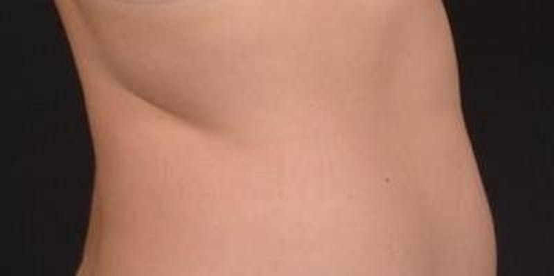BodyTite Before & After Gallery - Patient 364036 - Image 5