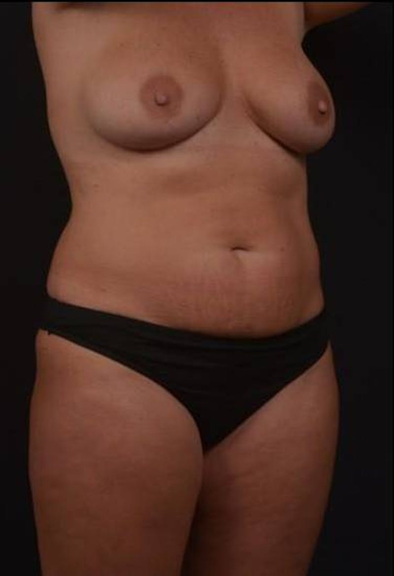 360 Liposuction Before & After Gallery - Patient 351706 - Image 7