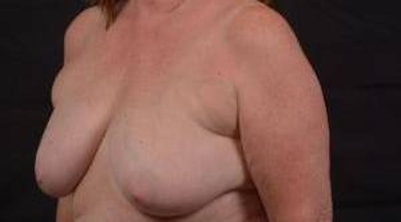 Immediate Breast Reconstruction – Skin Sparing Before & After Gallery - Patient 162765 - Image 7