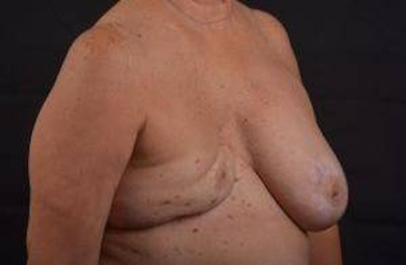 Reconstructive Breast Revision Before & After Gallery - Patient 347729 - Image 9