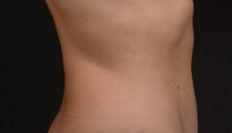 BodyTite Before & After Gallery - Patient 364036 - Image 6