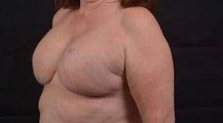 Immediate Breast Reconstruction – Skin Sparing Before & After Gallery - Patient 162765 - Image 8