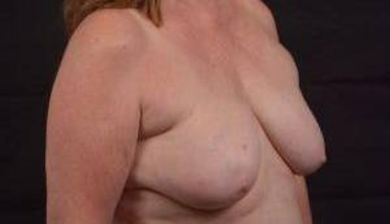 Immediate Breast Reconstruction – Skin Sparing Before & After Gallery - Patient 162765 - Image 9