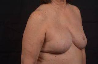 Reconstructive Breast Revision Before & After Gallery - Patient 347729 - Image 10