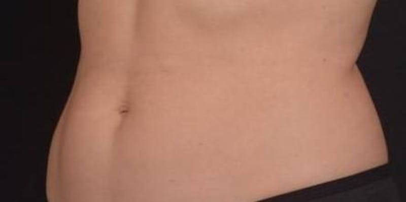 BodyTite Before & After Gallery - Patient 364036 - Image 7