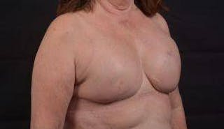 Immediate Breast Reconstruction – Skin Sparing Before & After Gallery - Patient 162765 - Image 10