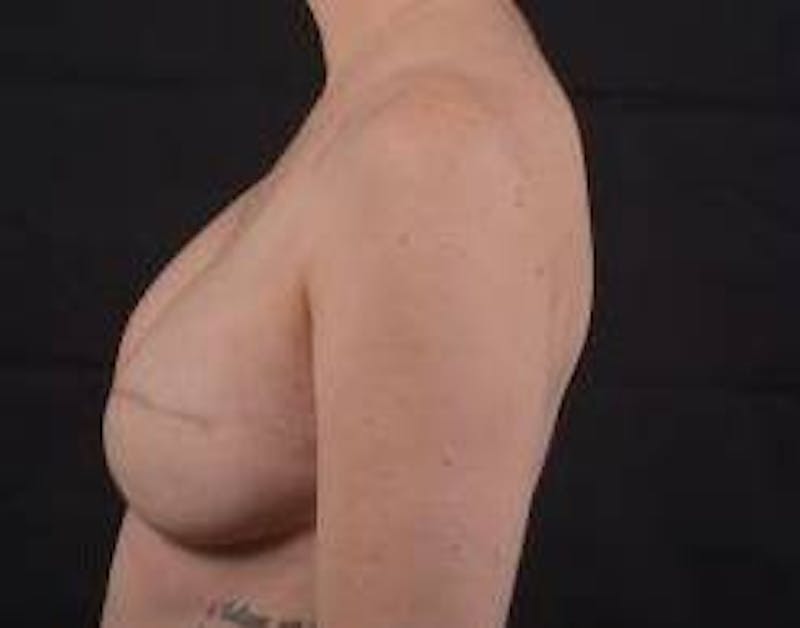 Reconstructive Breast Revision Before & After Gallery - Patient 137861 - Image 3