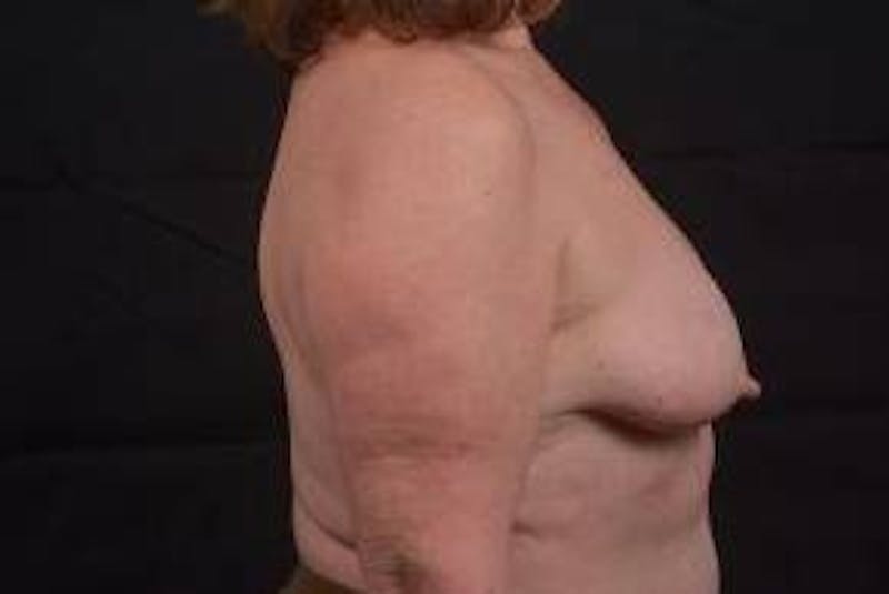 Immediate Breast Reconstruction – Skin Sparing Before & After Gallery - Patient 498308 - Image 3