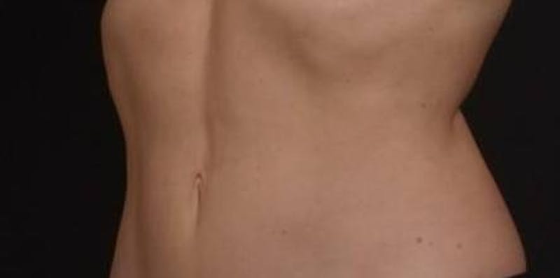 BodyTite Before & After Gallery - Patient 364036 - Image 8