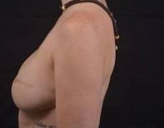 Reconstructive Breast Revision Before & After Gallery - Patient 137861 - Image 4