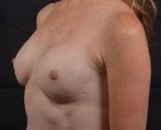 Immediate Breast Reconstruction – Nipple Sparing Before & After Gallery - Patient 331014 - Image 8
