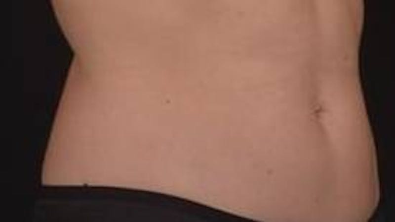 BodyTite Before & After Gallery - Patient 364036 - Image 9