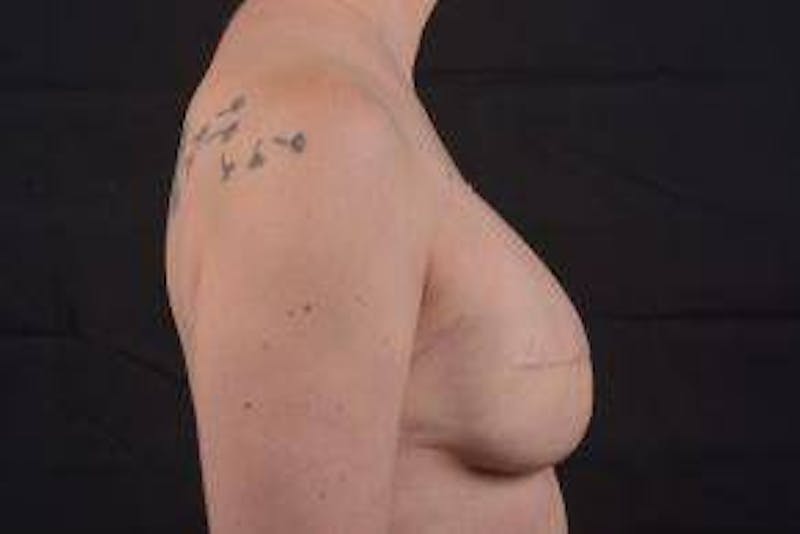 Reconstructive Breast Revision Before & After Gallery - Patient 137861 - Image 5