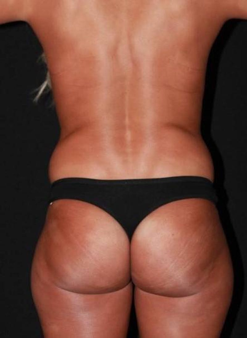 360 Liposuction Before & After Gallery - Patient 174936 - Image 11