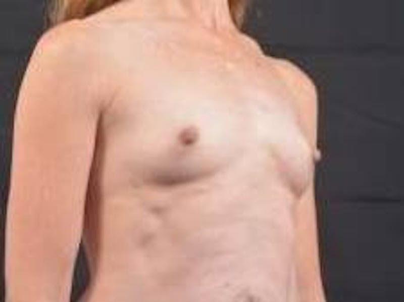 Immediate Breast Reconstruction – Nipple Sparing Before & After Gallery - Patient 331014 - Image 9