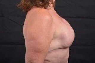 Immediate Breast Reconstruction – Skin Sparing Before & After Gallery - Patient 498308 - Image 4