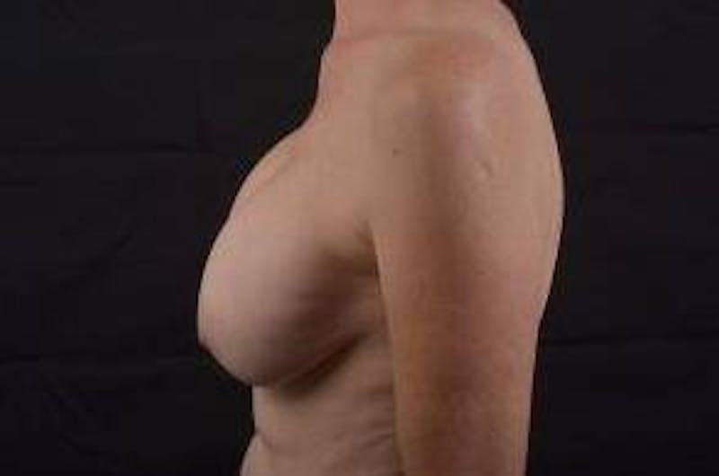 Breast Augmentation Mastopexy Before & After Gallery - Patient 206043 - Image 3