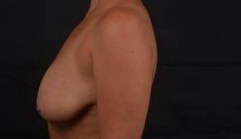 Mastopexy Before & After Gallery - Patient 288121 - Image 3