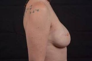 Reconstructive Breast Revision Before & After Gallery - Patient 137861 - Image 6