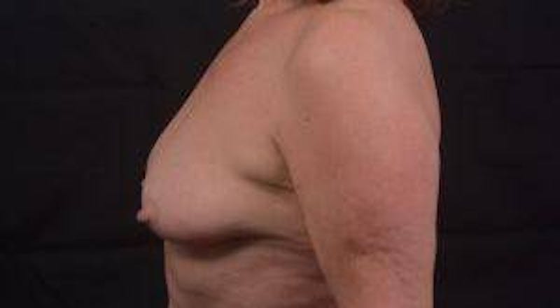 Immediate Breast Reconstruction – Skin Sparing Before & After Gallery - Patient 498308 - Image 5