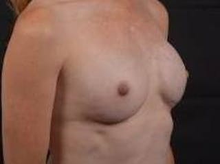 Immediate Breast Reconstruction – Nipple Sparing Before & After Gallery - Patient 331014 - Image 10