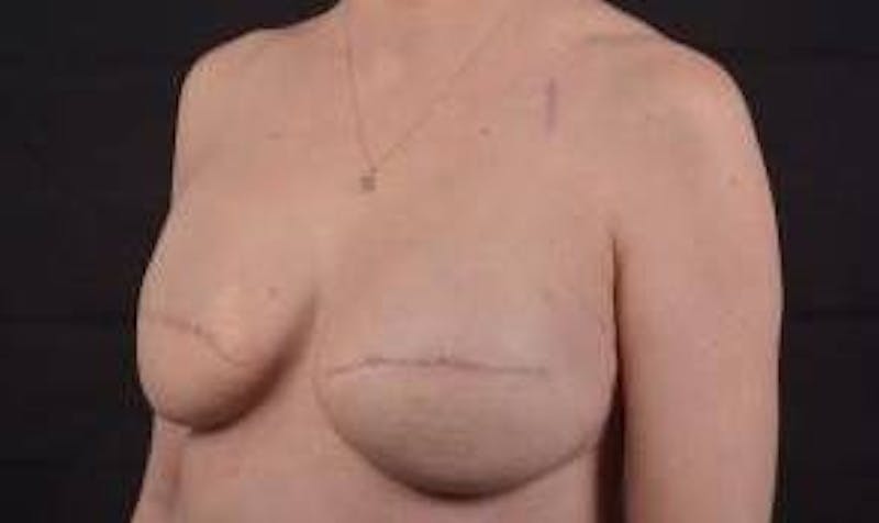 Reconstructive Breast Revision Before & After Gallery - Patient 137861 - Image 7