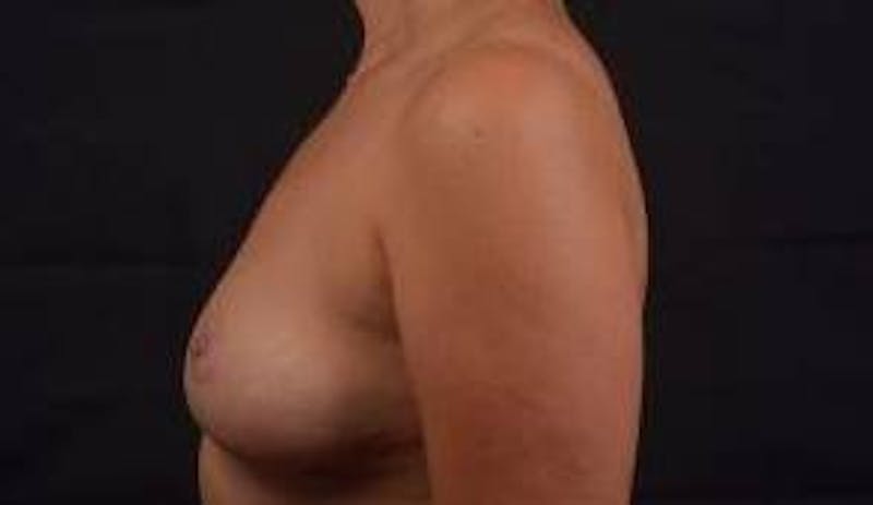 Mastopexy Before & After Gallery - Patient 288121 - Image 4