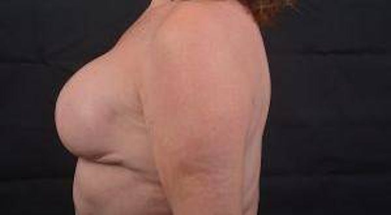Immediate Breast Reconstruction – Skin Sparing Before & After Gallery - Patient 498308 - Image 6