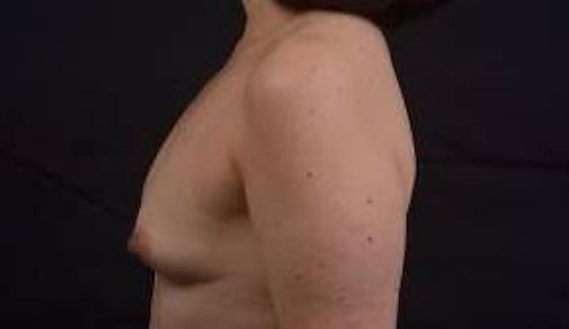 Immediate Breast Reconstruction – Nipple Sparing Before & After Gallery - Patient 133183 - Image 3